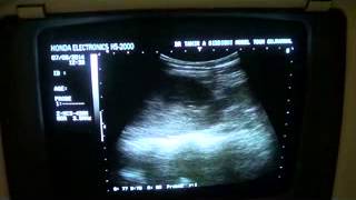 PYELONEPHRITIS vs INTERSTITIAL NEPHRITIS vs NEPHROTIC SYNDROME [upl. by Nallad401]