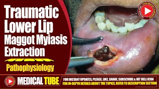 Traumatic Lower Lip Maggot Myiasis Extraction  Pathophysiology 2024  InDepth Analysis [upl. by Wolff]