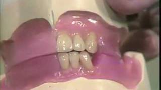 Setting Mandibular Anterior Teeth [upl. by Yevad]