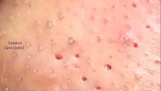 Blackhead Removal on his nose  Acne Treatment  Remove Blackhead removeblackhead [upl. by Allerim]