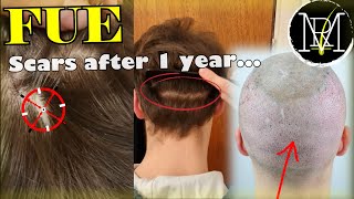 Scars after FUE Hair Transplant How visible are they [upl. by Caryn]