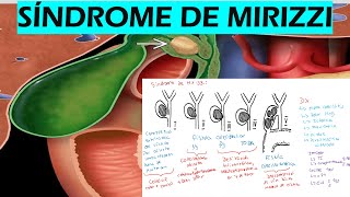 SÍNDROME DE MIRIZZI [upl. by Anirehtac]