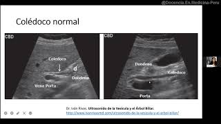 Ecografía de colédoco [upl. by Eniagrom]