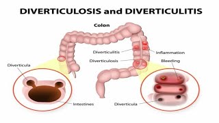 You Wont Believe What Happens Inside Your Colon viral [upl. by Relyks379]