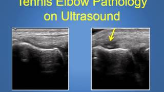 Tennis Elbow Treatment Explained by a Top Phoenix Orthopedic Surgeon 480 2193342 [upl. by Bushore]