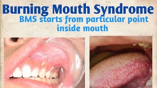 Burning Mouth SyndromeBurning Mouth start from particular point inside mouth and spread to all over [upl. by Tabby]