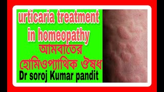 Urticaria treatment। homeopathy। আমবাতের হোমিও ঔষধ। আমবাত কি কেন হয় [upl. by Cornela296]