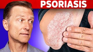 Psoriasis Treatment – The Best 3 Remedies for Psoriasis – DrBerg [upl. by Mannes]