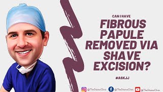 Can I have a fibrous papule removed via shave excision [upl. by Ehsiom]