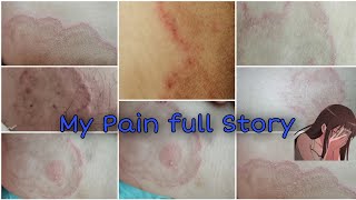 Ringworm KharishTinea Cruris How I Recover After 6 Month Complete Detail Vedio On Skin خارش چمبل [upl. by Enirak]