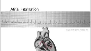 Tachycardia Basic Discussion [upl. by Yadahs240]