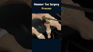 Hammer Toe Surgery Understanding the Procedure surgeryanimation [upl. by Urina742]