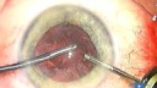 Capsular Tension Rings Introduction Phaco 33 Complications [upl. by Modnarb]