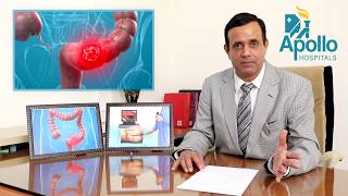 Colonoscopy Sigmoidoscopy in Hindi Dr Shravan Bohra liver specialistApolloAhmedabad [upl. by Yalhsa]