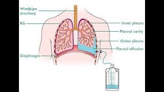 drainage pleural [upl. by Lehcir]