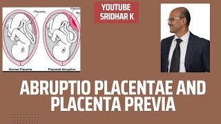 Abruptio placentae and placenta previawhat are these conditions APH bleeding abruption previa [upl. by Josh361]