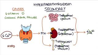 Understanding Hyperparathyroidism [upl. by Zellner]