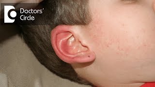 What can be done for Swollen Ear caused by concentrated antiseptic  Dr Sriram Nathan [upl. by Notsyrb642]