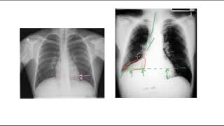 🔴 PNEUMONIE PLEURESIE INFARCTUS OU ATELECTASIE [upl. by Fuld571]