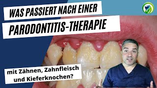 Was passiert mit Zähnen Zahnfleisch und Kieferknochen bei einer Parodontitistherapie [upl. by Staci]