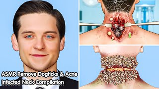 ASMR Deeply Cleansing Neck Infected with Acne and Dogticks [upl. by Tandy]