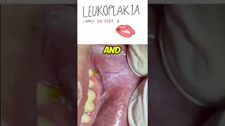 Oral Leukoplakia  Dentogenesis [upl. by Pomona]