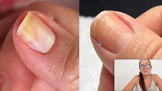 How she regrew her separated nail Onycholysis [upl. by Lennad]