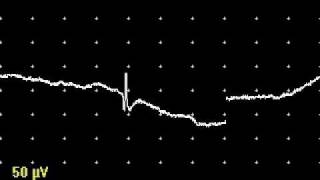 Positive Waves and Fibrillation Potentials [upl. by Eadas]