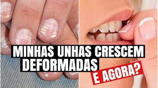 MINHAS UNHAS CRESCEM ARREBITADAS O QUE FAZER rafaresponde [upl. by Aufmann588]