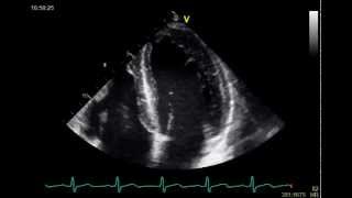 ECHO LEARNING GUIDE 4 3 and 2 CHAMBERS [upl. by Krischer]