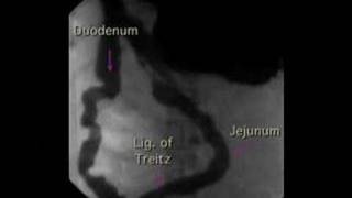 Lower GI Movies  Duodenal Peristaltic Waves [upl. by Rhines]