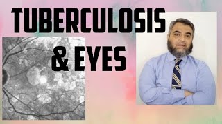 TUBERCULOSIS AND EYES Tuberculosis EyeinfectionRifampicinisoniazidethambutol [upl. by Zechariah563]