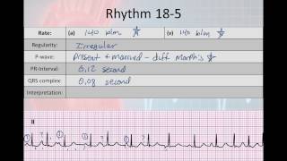 Basic Electrophysiology part 7  Atrial Rhyhtms part 2 WAP MAT EAT SVT [upl. by Allerus65]