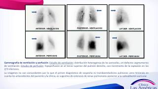 Casos Clínicos Estenosis venas pulmonares [upl. by Carli]