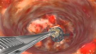 Animation Scar Tissue Removal to Release TORP [upl. by Hochman]