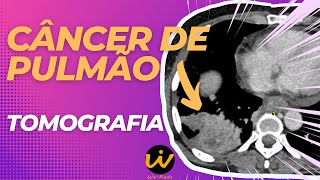 CÂNCER de PULMÃO  Neoplasia Pulmonar na TC de Tórax [upl. by Yejus216]