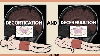 Decerebration vs Decortication  Understanding Neurological Postures amp Brain Damage [upl. by Acina]