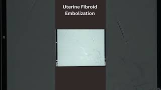 Uterine Fibroid Embolization [upl. by Dihsar]