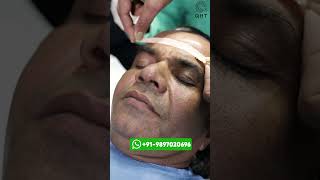 Rajpal Yadav Hair Transplant Result  Latest Fue Technique shorts viral hair transplant [upl. by Lexa]