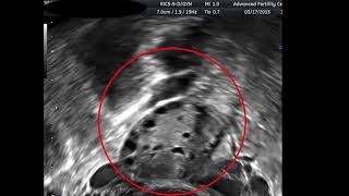 Antral Follicle Counts in Real Time [upl. by Enieledam672]