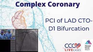 PCI of LAD CTOD1 Bifurcation  November 2017 [upl. by Simmonds]