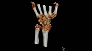 Comminuted distal radius fracture [upl. by Ike]