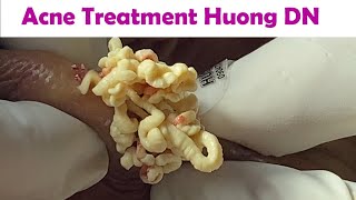 Acne Treatment Huong Da Nang  2024 Acne Huong 715 [upl. by Luane]