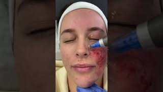 Microneedling with Dermapen 4 at DRMEDISPA [upl. by Orelia]