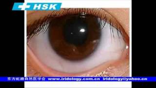 2009 Iridologia Software  East Iridology Hsk iriscope HSK Camara para iridologia Medicina Natural Holistica  Iridologia Acupuntura Florais Cromoterapia [upl. by Hannazus]