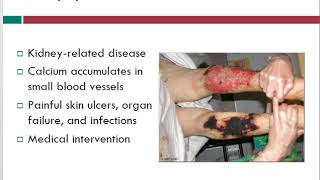 Calciphylaxis  Wound Care Topics  Free Wound Care Info  WoundEducatorscom [upl. by Pellet]