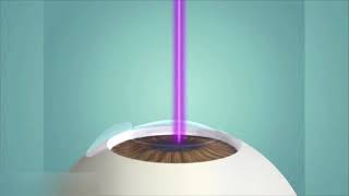 Lasik et PresbyLasik  Opération laser des yeux  Myopie astigmatisme hypermétropie et presbytie [upl. by Aimac]