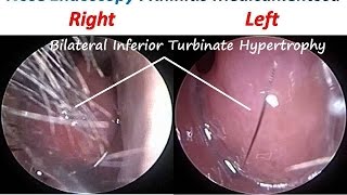 Nose Endoscopy  Rhinitis Medicamentosa Drug Induced RhinitisTopical Nasal Decongestants [upl. by Peedus427]