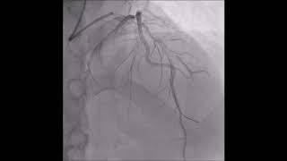 Manual thrombus aspiration is still needed during a transradial primary PCI of a 36 years old male w [upl. by Tacklind]