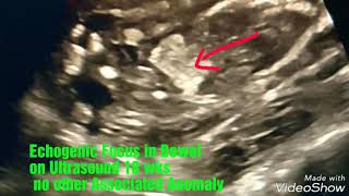 Echogenic Focus in Bowel in 2nd Trimester Ultrasound [upl. by Nanny]